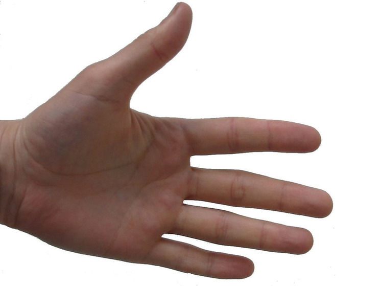 Московские врачи избавили девушку от чрезмерно потных ладоней