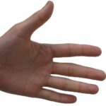 Школьницу избавили  от потных ладошек